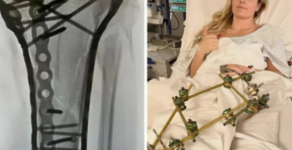 Шраф до шрафа: Овако сада изгледа нога Линдзи Вон (ВИДЕО)