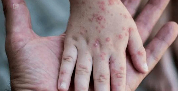 Majmunske boginje – izgled, simptomi i dijagnostika