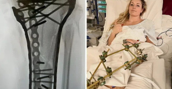 Шраф до шрафа: Овако сада изгледа нога Линдзи Вон (ВИДЕО)